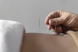 Dry needling therapy in Edmonton