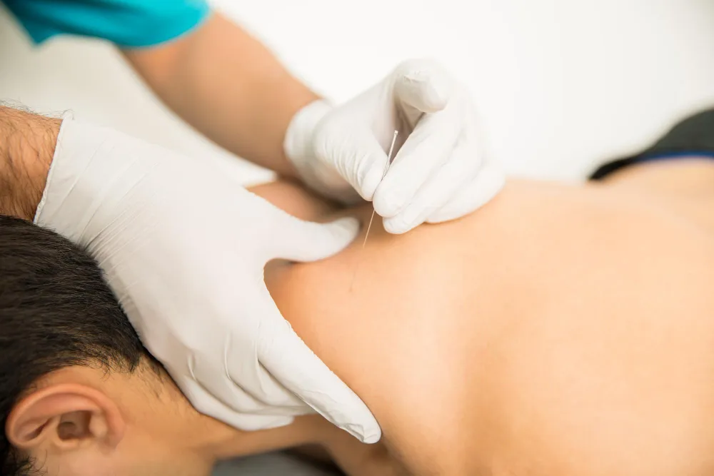 Dry needling therapy in Edmonton